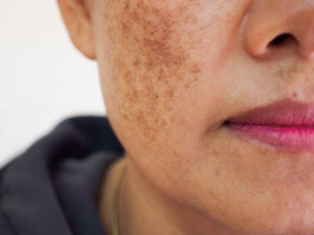 Hyperpigmentation - Photo Gallery