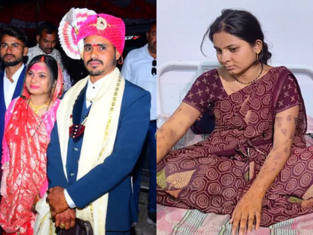 Madhya Pradesh Woman Burned with Hot Knife by Husband in Dowry Violence Case