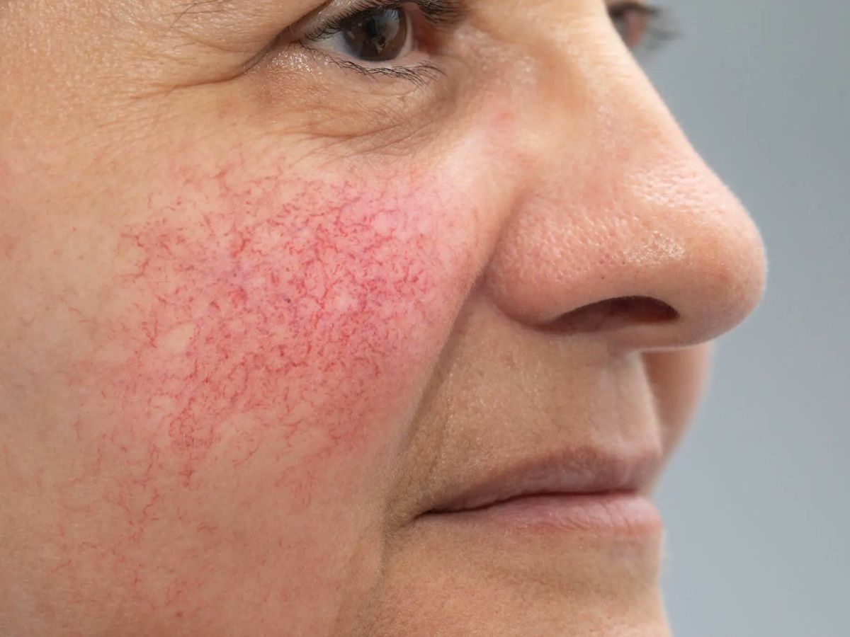 Rash on skin - Photo Gallery