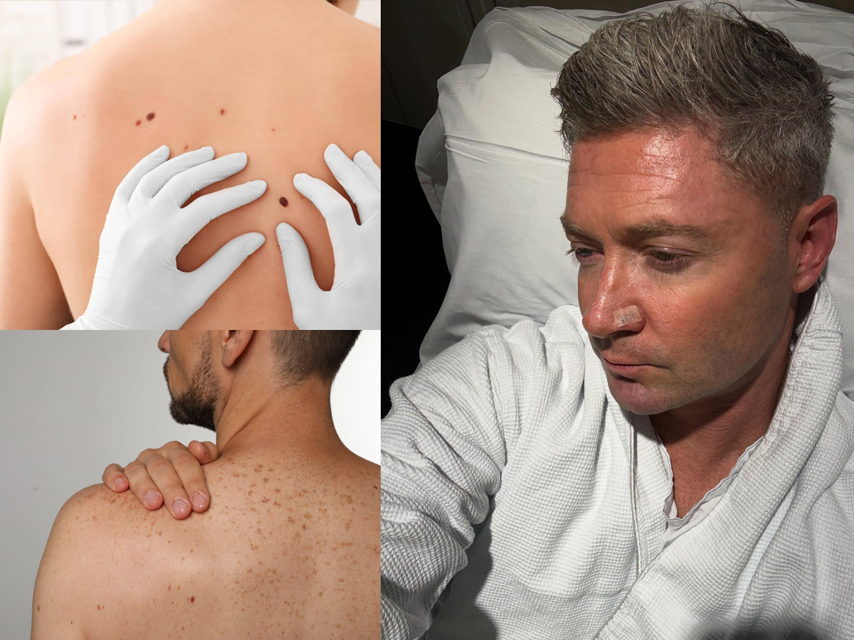Michael Clarke’s Skin Cancer Diagnosis: Australia Tops Global Rates, Where Does India Stand?
