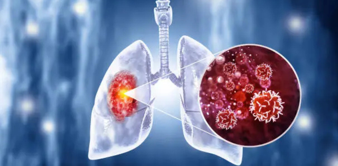 World Lung Cancer Day: Spreading Awareness, Inspiring Action