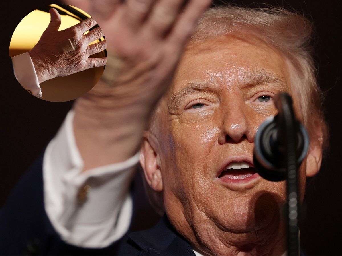 Fact Check | Bruises, Bandages on Trump’s Hand and ‘Sleeping in Meetings’: Is He Really Suffering From a Disease?