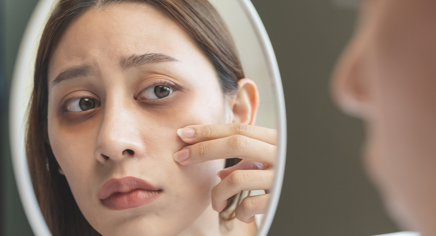 Tired Eyes Are Talking — Are You Listening? The Truth About Dark Circle Treatment in Bangalore